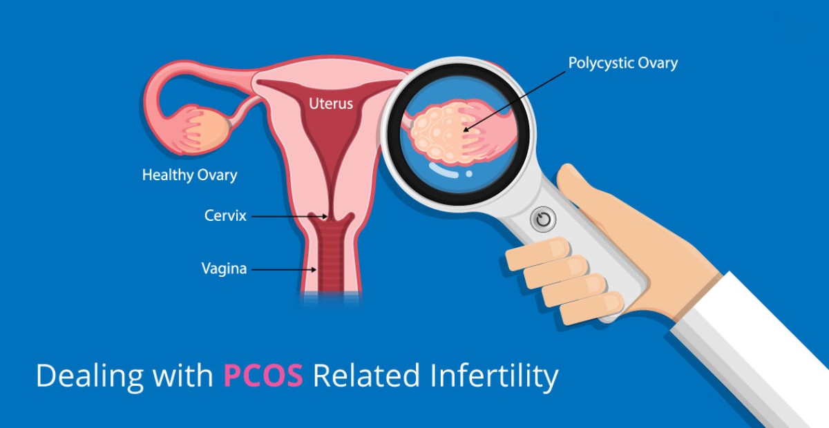 How to deal with PCOS
