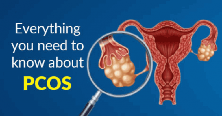 PCOS Causes & Treatment